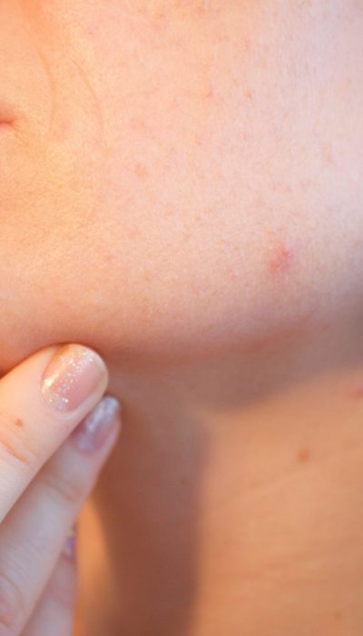 acne-1606765